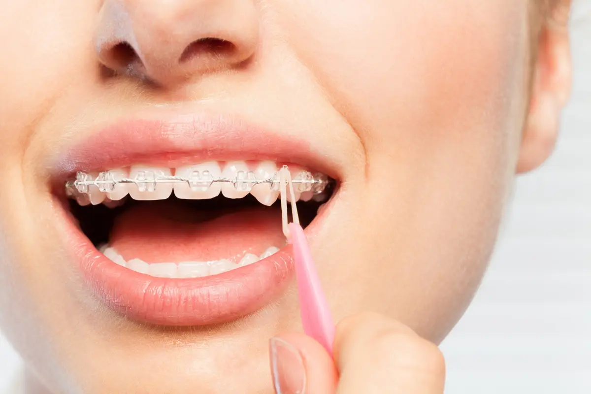 Orthodontic Ligatures for Braces